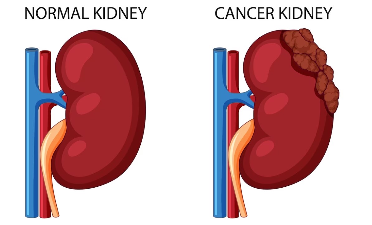 kidney cancer